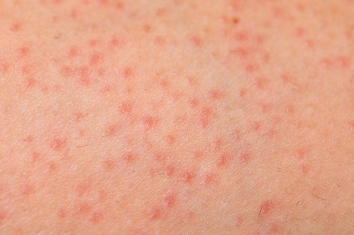 Cegah iritasi kulit dengan deterjen berformula ringan