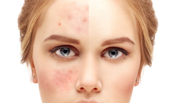 Kandungan anti-acne: Untuk mengatasi jerawat