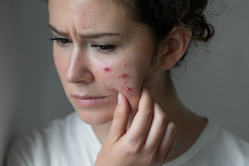 Kulit berjerawat, pertimbangkan produk yang mengandung acne care