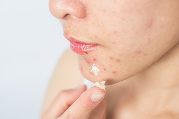 Untuk masalah jerawat: Moisturizer dengan kandungan bahan anti-acne