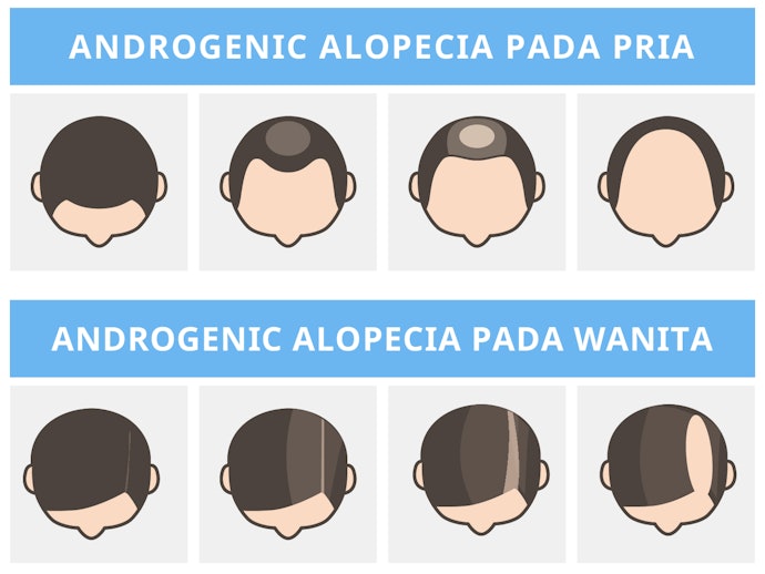 Saw palmetto, membantu mengatasi kondisi androgenetic alopecia (AGA)