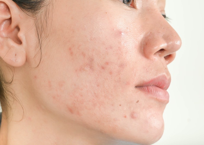 Kandungan anti-acne untuk kulit berjerawat