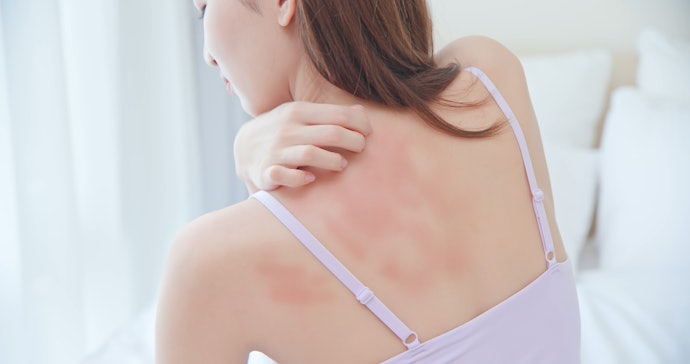 Tips merawat kulit jika terkena penyakit kulit 