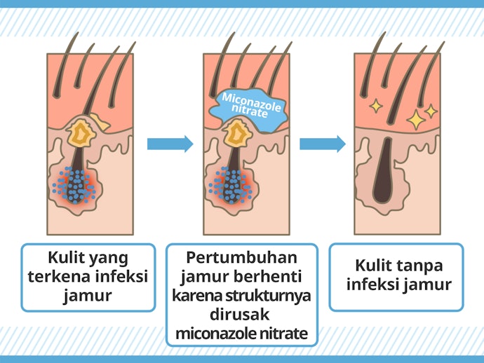 Miconazole nitrate, mengatasi jamur penyebab gatal