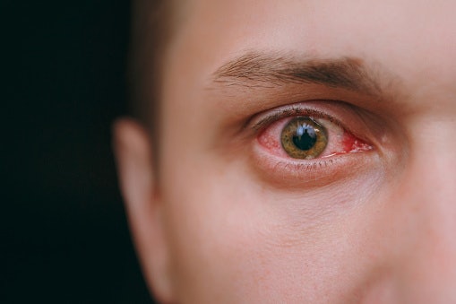 Bahan vasoconstrictor: Atasi mata merah saat diperlukan
